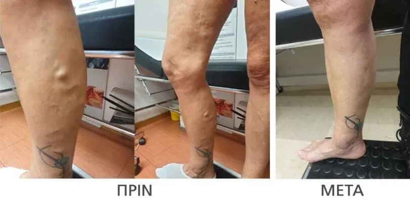 Χειρουργική αντιμετώπιση κιρσών Πριν & Μετά