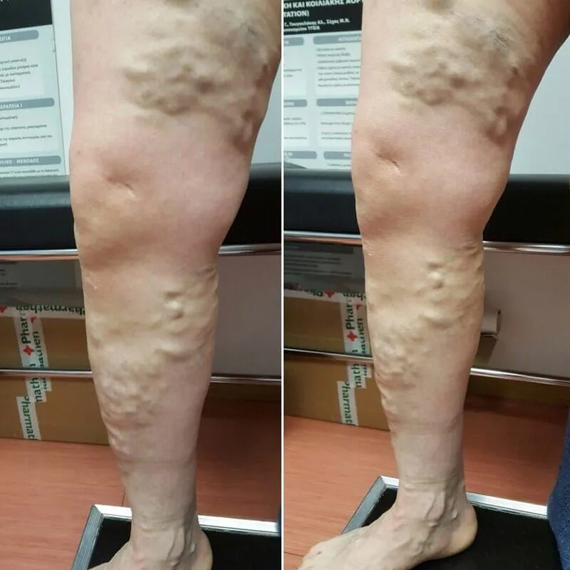 Βαριά φλεβική ανεπάρκεια σκέλους πριν την χειρουργική αντιμετώπιση