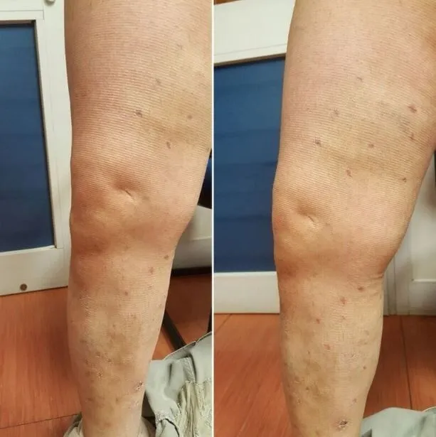 Βαριά φλεβική ανεπάρκεια σκέλους μετά την χειρουργική αντιμετώπιση