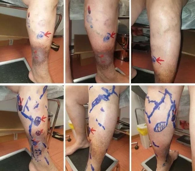 Βαριά φλεβική ανεπάρκεια με σοβαρές δερματικές αλλοιώσεις & αρχόμενο άτονο φλεβικό έλκος (Πριν την αντιμετώπιση)