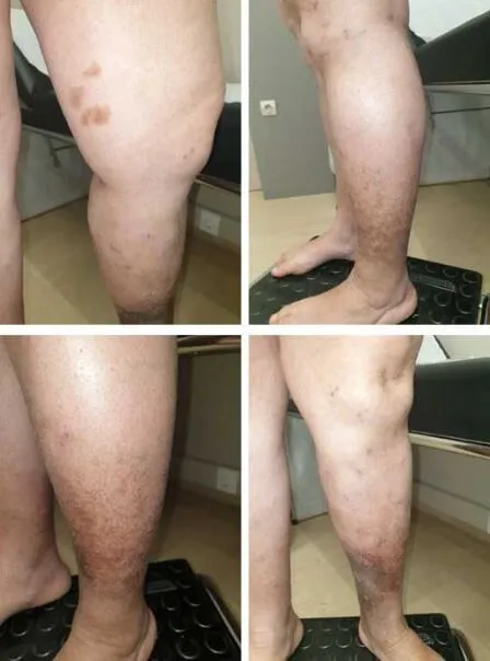 Βαριά φλεβική ανεπάρκεια με σοβαρές δερματικές αλλοιώσεις. Επούλωση του άτονου φλεβικού έλκους