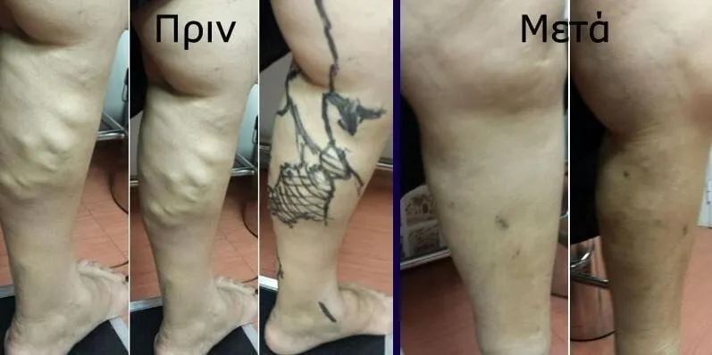 Θεραπεία εκσεσημασμένων κιρσών